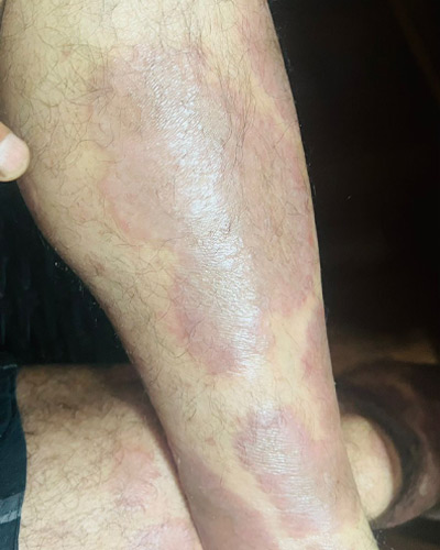 Before & After images of Psoriasis